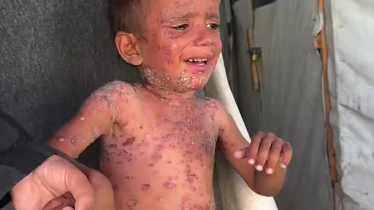 The terrorist Zionist occupation spreads diseases against children in Gaza