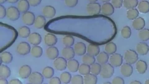 Her red blood cells are very inflamed and also have spikes on them. This is not healthy blood