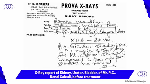 ACH - CASE PPT - U001-RENAL CALCULI-RC