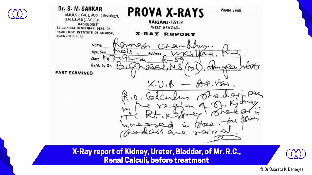 ACH - CASE PPT - U001-RENAL CALCULI-RC