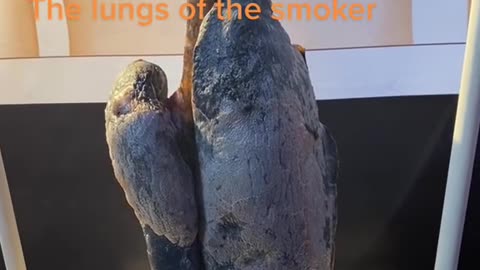 The lungs of smoking