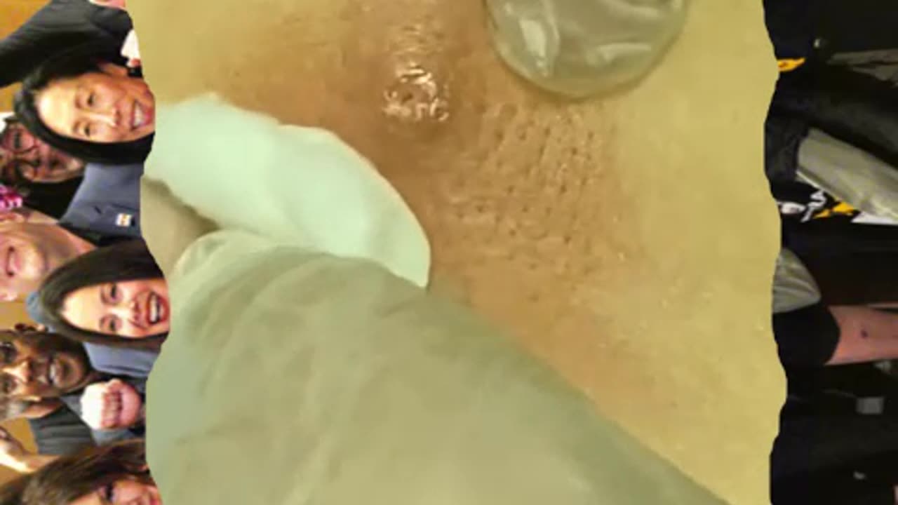 Pimple popping and blackhead