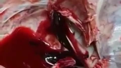 Autopsy of vaccinated with thrombosis after two doses of Pfizer!