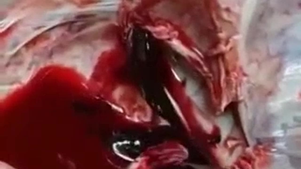 Autopsy of vaccinated with thrombosis after two doses of Pfizer!