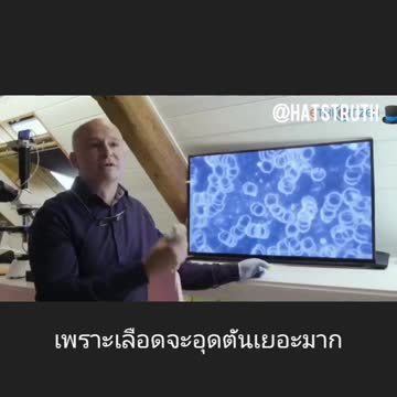 การอุดตันของเม็ดเลือดแดงหลังฉีดวัคซีน (ผ่านกล้องจุลทรรศน์)