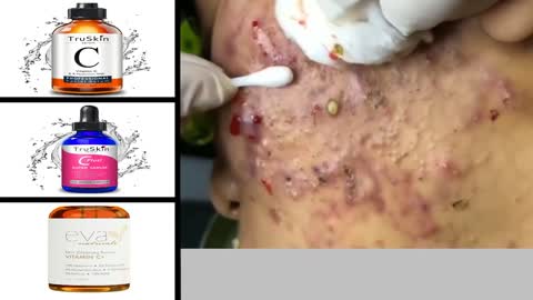 Blackheads Removal & Pimple Popping Videos 2022