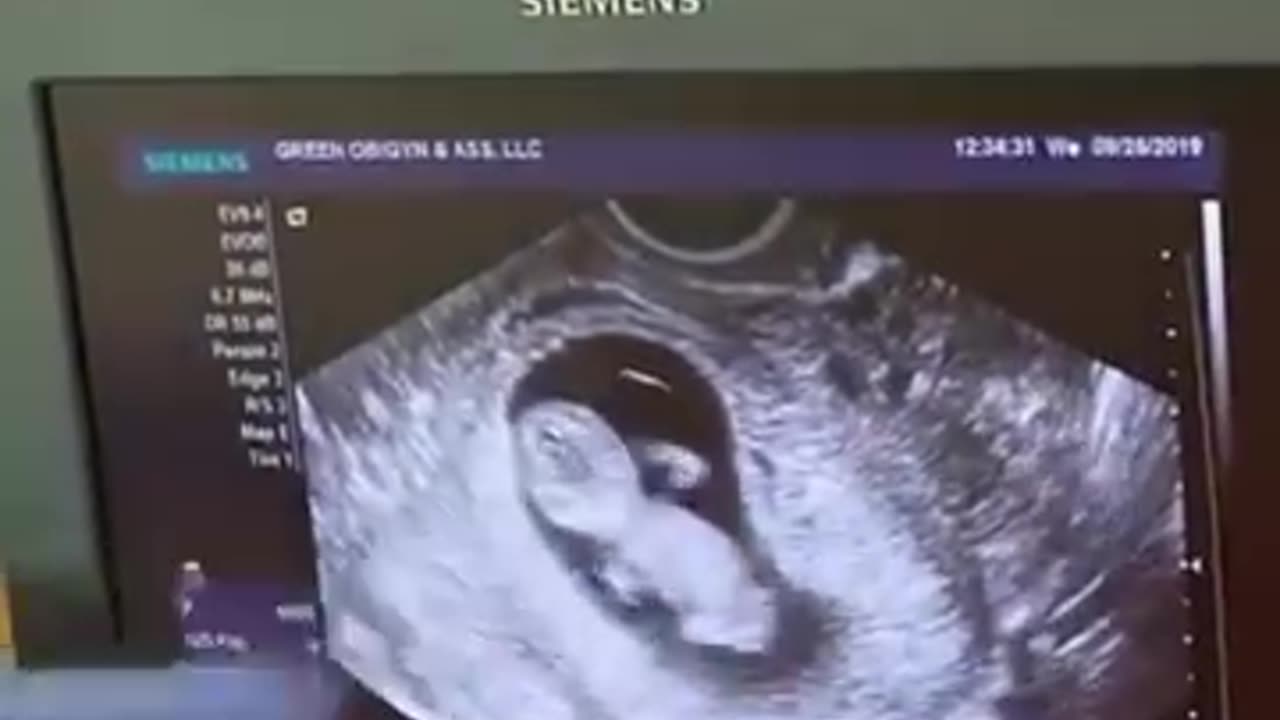Ultrasound
