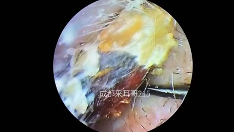 gigantic ear wax removal #42