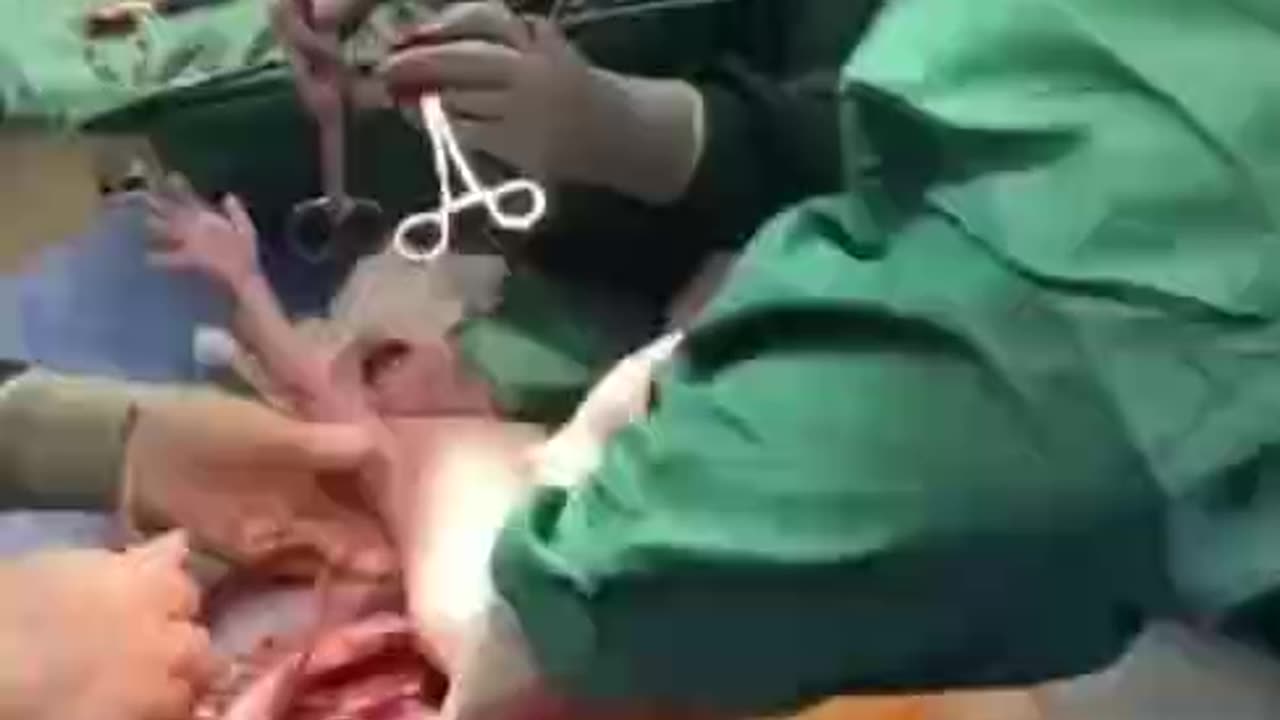🖥 Multiple caesarean section
