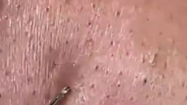 Giants Deep Blackheads, Whiteheads, Big Pimples, Hidden Acne Removal - Best Popping Videos #000008