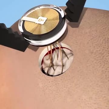 This is how they install a Neuralink...