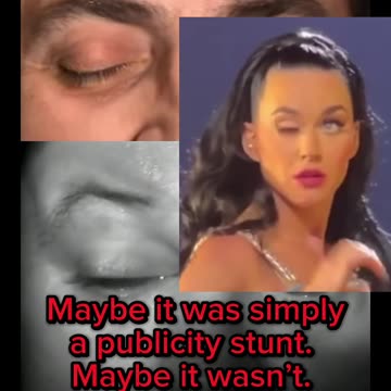 NEW STUDY: COVID VACCINES CAUSE EYE/LID PARALYSIS