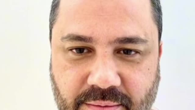 Hair transplant results FUE technique