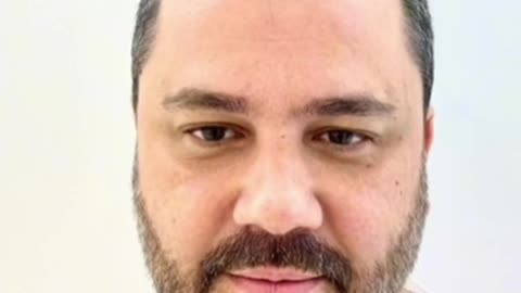 Hair transplant results FUE technique