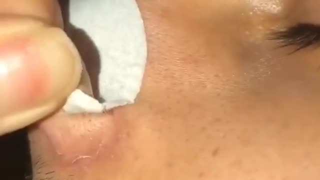 Blackhead Extraction and Pore Strip Compilation