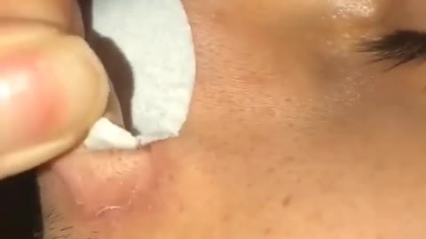 Blackhead Extraction and Pore Strip Compilation