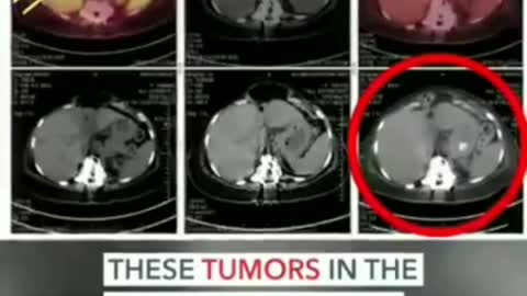 40 YEARS AGO THE CURE FOR CANCER WAS DISCOVERED