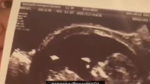孕婦打針 胎死腹中 南無阿彌陀佛 🙏
