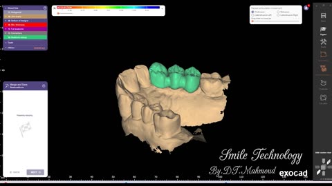#design #naildesign #dental #dentaldesign #exocadexpert