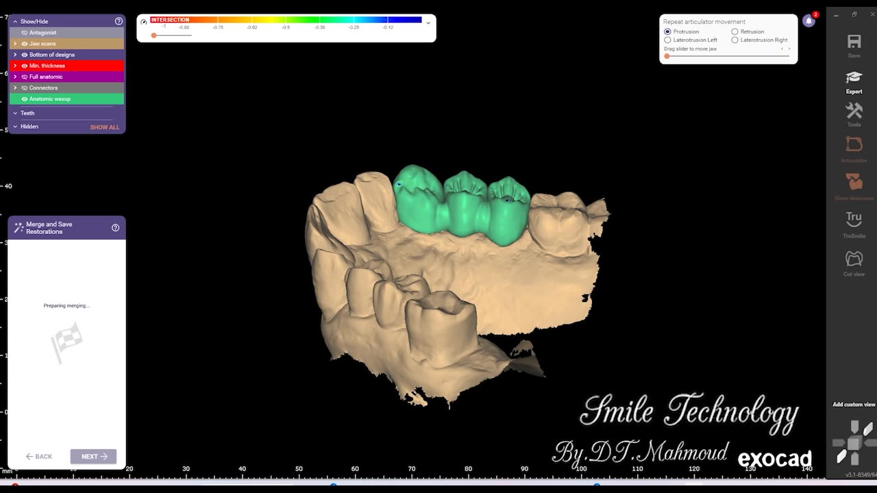 #design #naildesign #dental #dentaldesign #exocadexpert