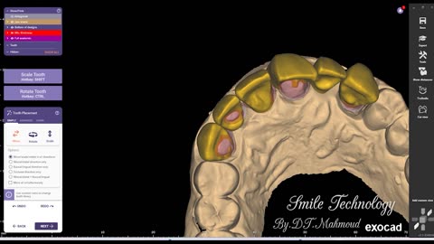 How to design 6 anterior teeth dental design by exocad