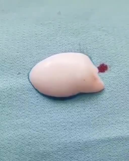 Removing the bloodstain