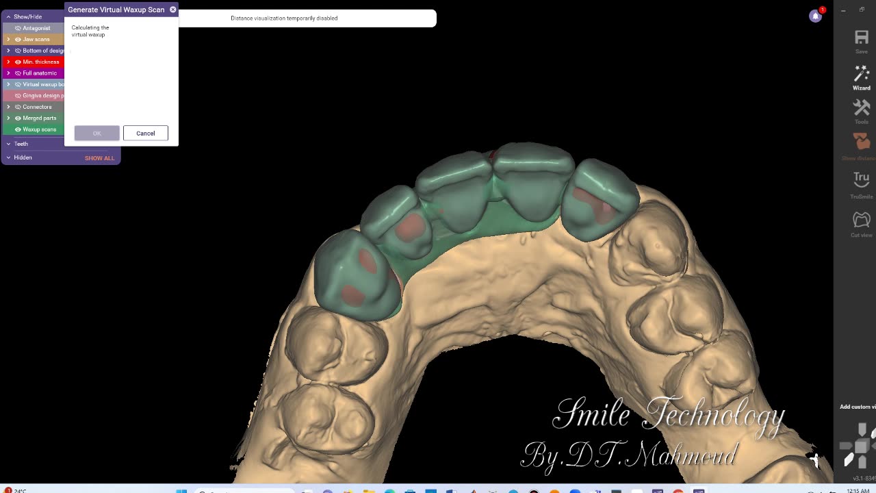 #design #naildesign #dental #dentaldesign #exocadexpert