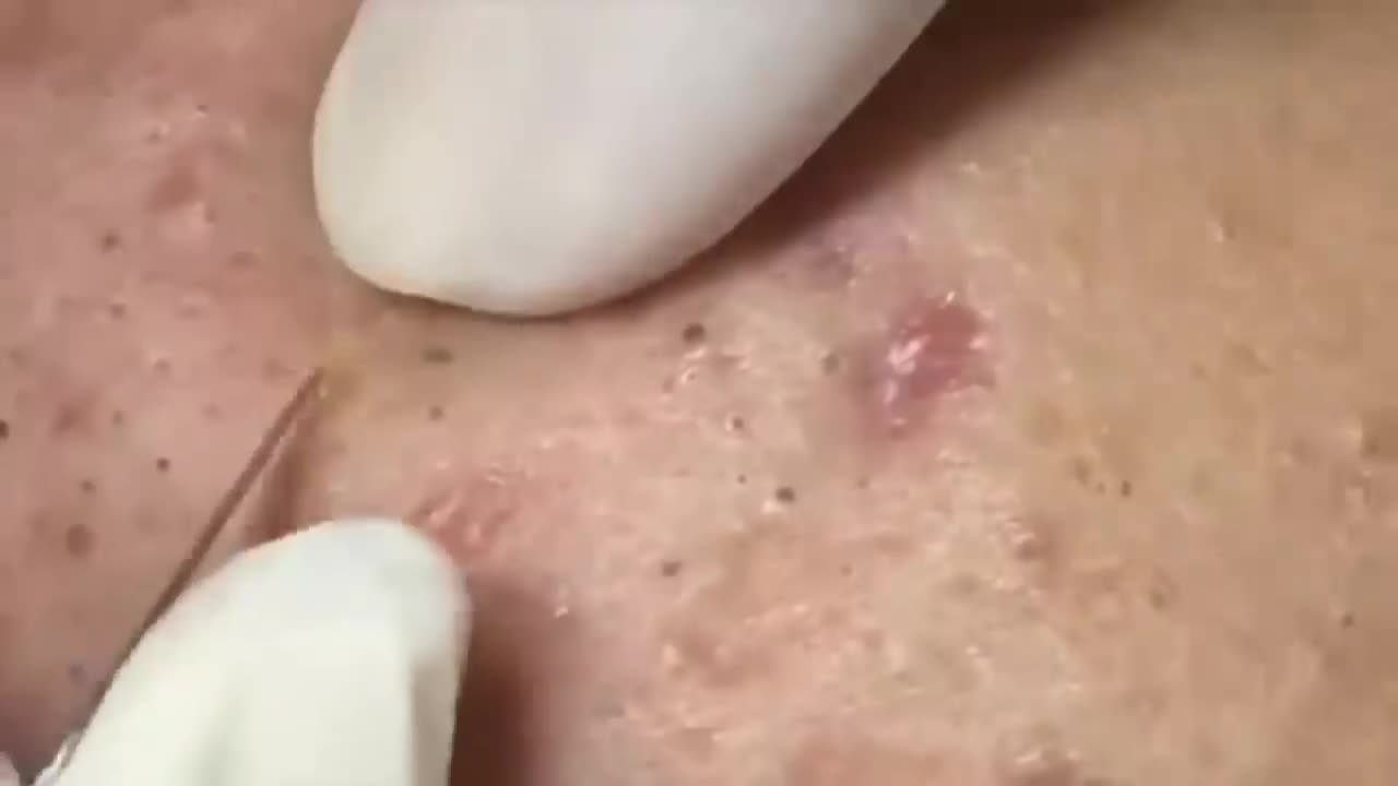removing giant blackhead