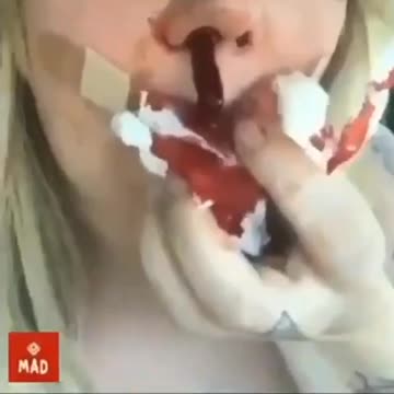 “18禁_1”，在施打新冠疫苗實驗針劑（C_19 vaccine）受害者身上（鼻腔），拉出來的血凝塊（blood clots）