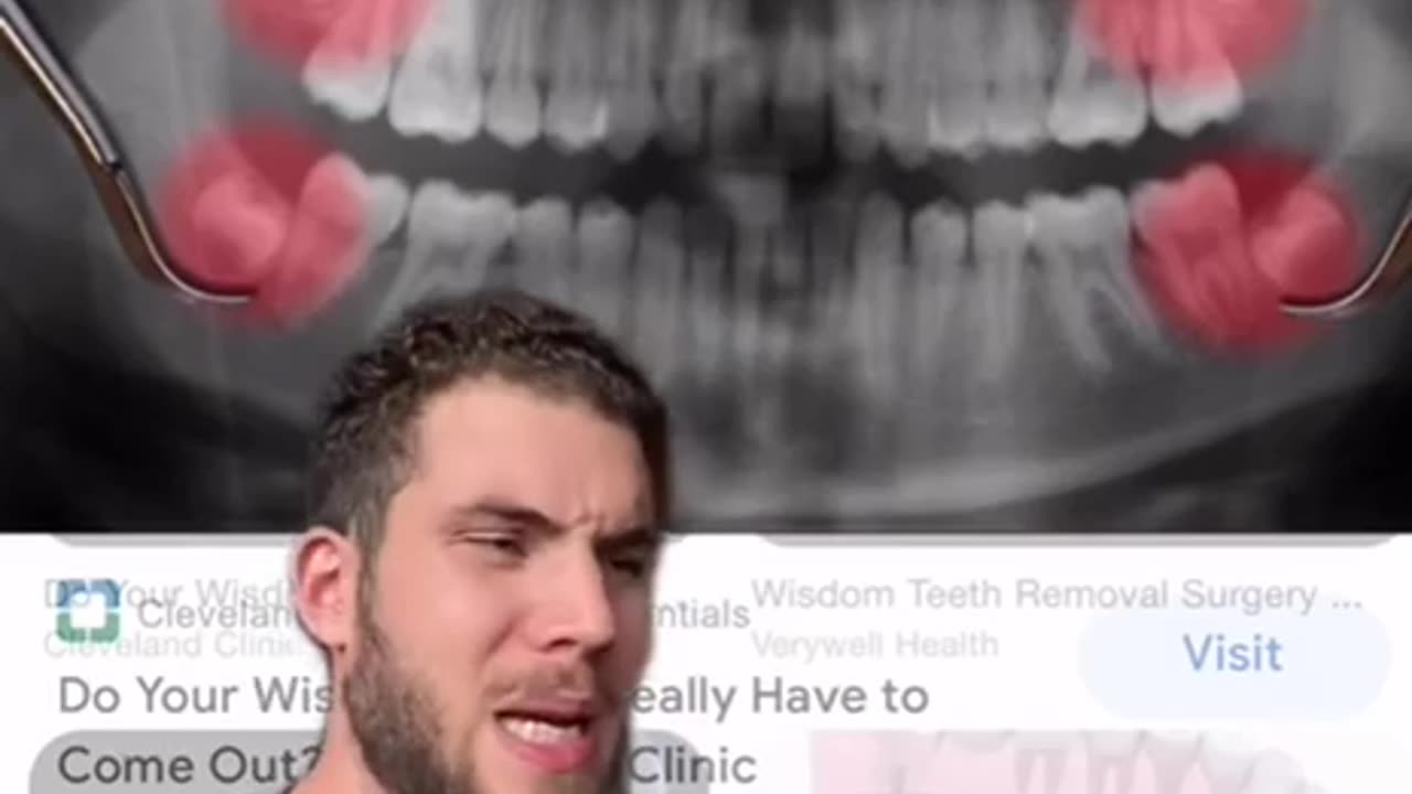 The Truth about Wisdom Teeth 🦷