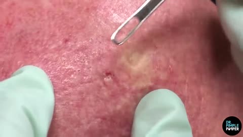 A Forehead of Blackhead Extractions! Dr Pimple Popper Mines a Patient's Head