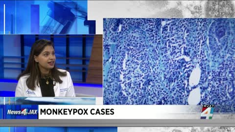 Monkeypox declared a public health emergency