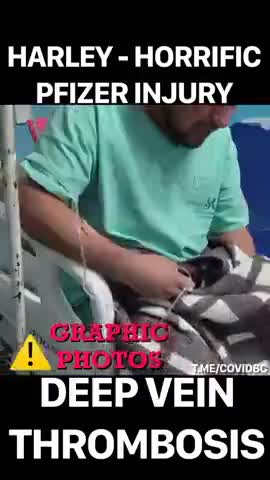 WARNING GRAPHIC: 33 YEAR OLD SUFFERS BLOOD CLOTS AND 2 CARDIAC ARRESTS FROM 1 PFIZER COVID VACCINE
