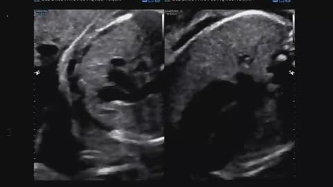 Baby ultrasound image and sound (4)