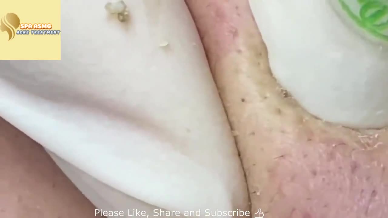 NEW TODAY! MASSIVE BLACKHEADS REMOVAL SPA ASMG!