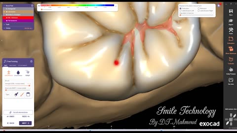 #design #naildesign #dental #dentaldesign #exocadexpert