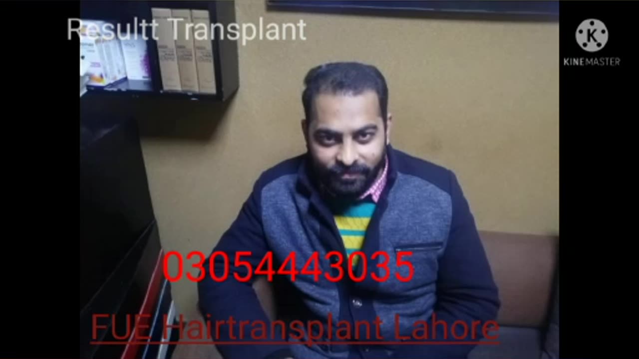 Fue hair transplant