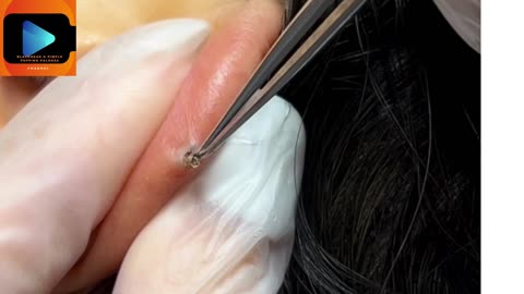 Very Satisfying Video of Extracting Small Blackheads