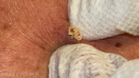 6 Satisfying Pimple Popping Videos