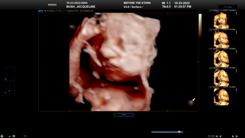 Baby Bush Ultrasound 3