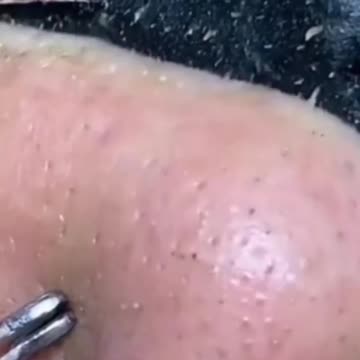 Nose Full Of Blackheads. Blackheads Removal With Pore Strips.