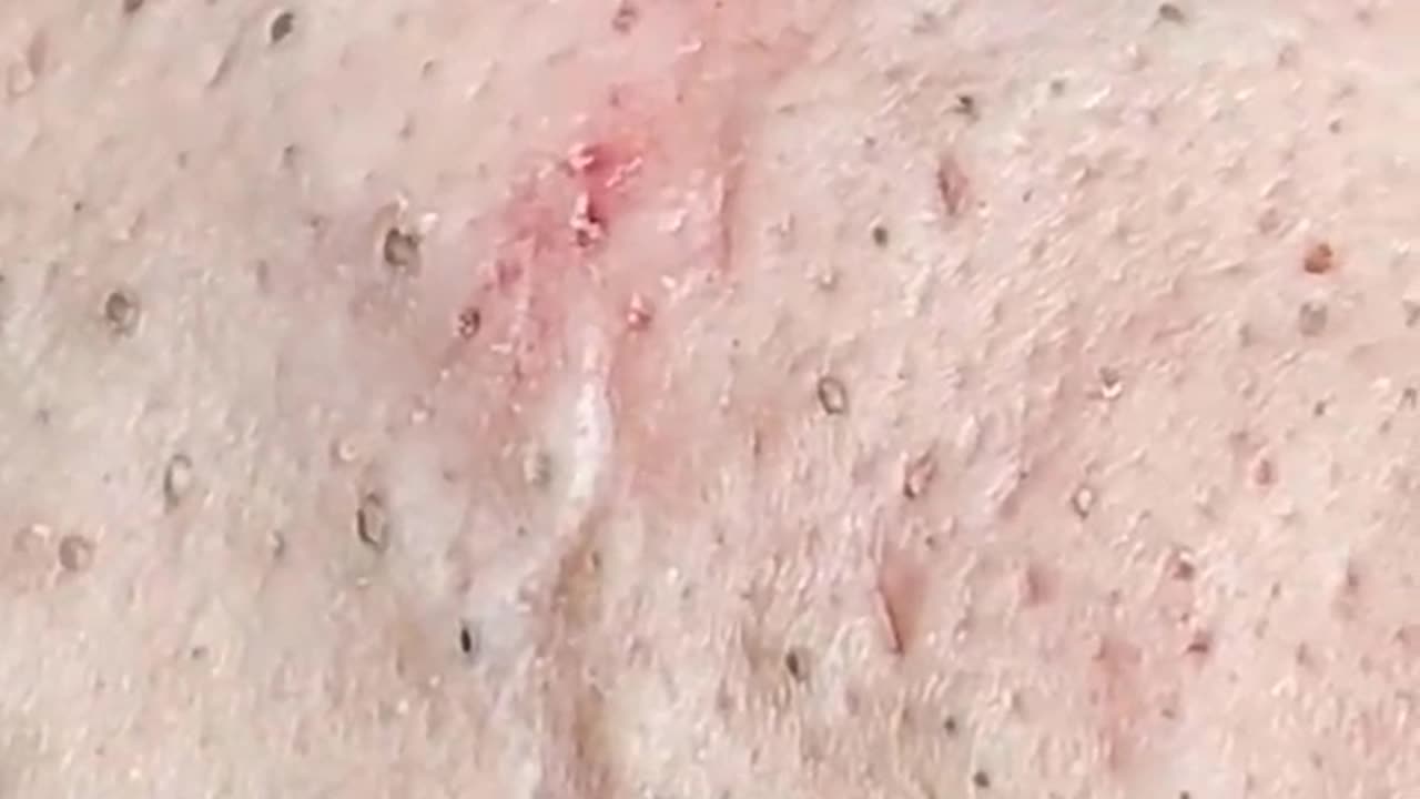 pimple popping