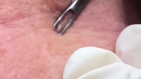 Creamiest Blackhead! Dr Pimple Popper Pops MASSIVE Blackhead