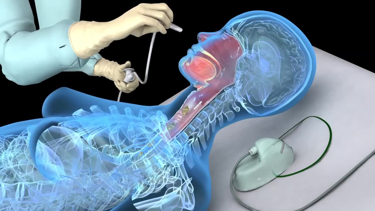 Nasotracheal Suctioning - 3D training animation