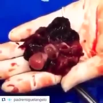 Was ist Abtreibung❓