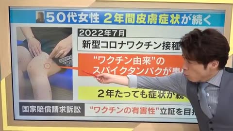 コロナワクチン接種後 手足に赤い斑点 2年たっても消えず…医師「40年で...一見たことない症例」スパイクタンパク検出が意味するのは？【大石が深掘り解説】