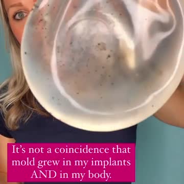 ❄️ Lyme Disease & Breast Implants
