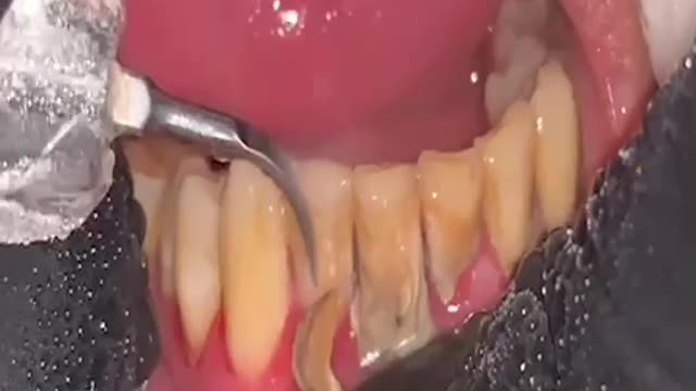 Root Canal Treatment 🙀🙀 #dental