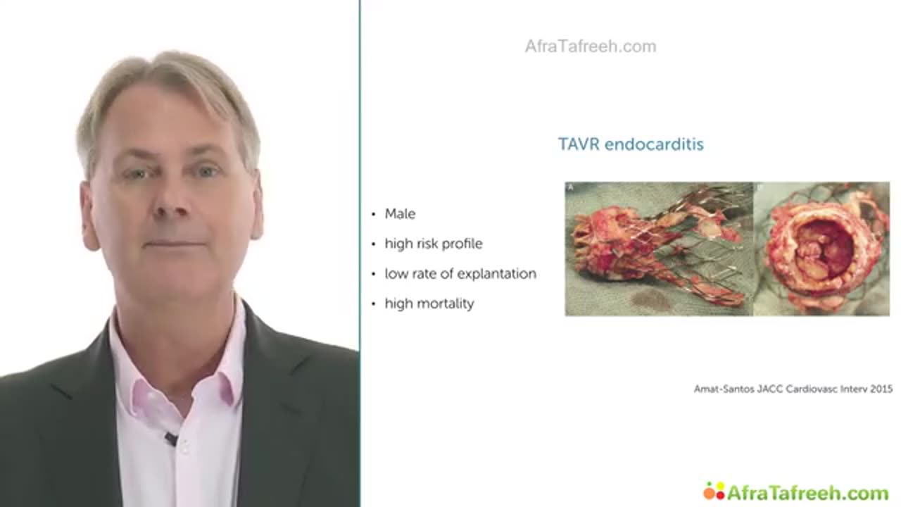 9. TEE on the ICU and After Cardiovascular Surgery TEE and CV Surgery - Part 2