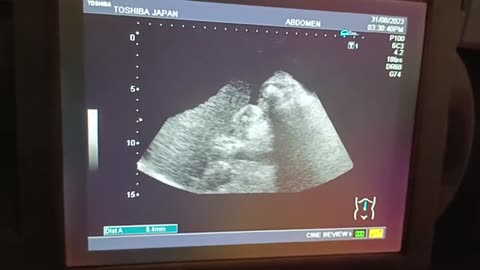 Mixed finding scan😮‍💨😮‍💨😮‍💨